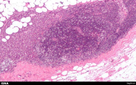 ارتقای بازدهی درمان سرطان پستان با هوش مصنوعی